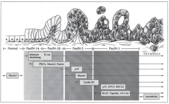 Figure  4.  «  PanINgram  »  ilustrant  la  progression  vers  le  cancer  pancréatique  à  partir  des  lésions précurseurs PanINs