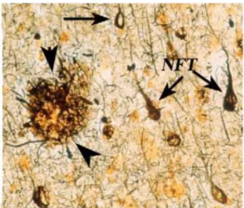 Figure 2 : Lésions anatomopathologiques spécifiques de la maladie d’Alzheimer    (Mroczko et al., 2018) NFT (flèches) plaque sénile (pointes de flèches)