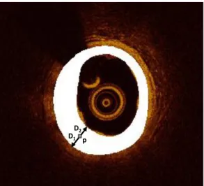 Figure 2: Schematic presentation of the two Euclidean distances calculated for defining the non-pathologic intima-media area (M)  within the WAR (white)