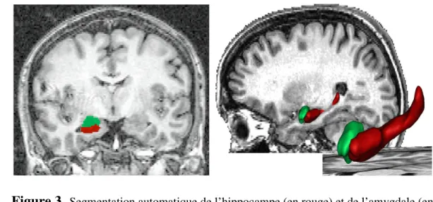 Figure 3 .  Segmentation automatique de l’hippocampe (en rouge) et de l’amygdale (en 2 
