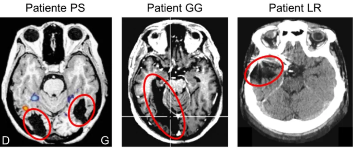 Figure 7. Exemples de lésions du VOTC à l'origine d'une prosopagnosie. Vue horizontale du cerveau  de la patiente PS (traumatisme crânien), du patient GG (accident vasculaire ischémique) et du patient LR  (traumatisme crânien)