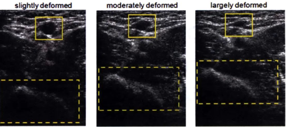 Figure  1-1  The  ultrasound  images  of brachial  artery  under compression