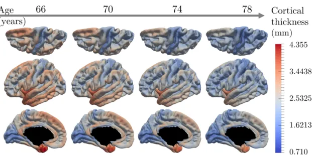 Figure 3.6: Estimated modes of evolution of the cortical thickness from 66 to 78 years old.