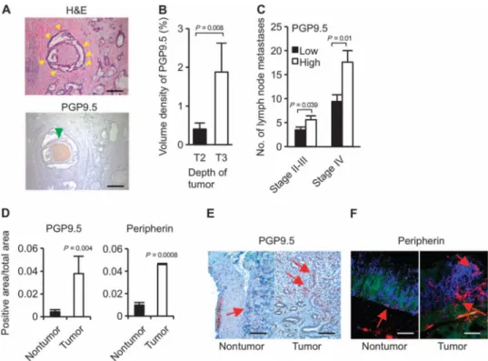 Fig. 8. PGP9.5 and peripherin may represent neural markers for gastric cancer progression (A) Representative microphotographs showing human gastric cancer [indicated by yellow  arrowheads, hematoxylin and eosin (H&amp;E) staining] and PGP9.5-labeled nerve 