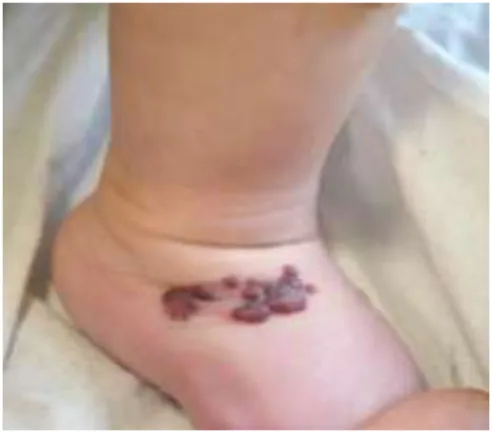 Fig. 1 : Nodules violacés du dos du pied droit, à l’âge de 5 mois 