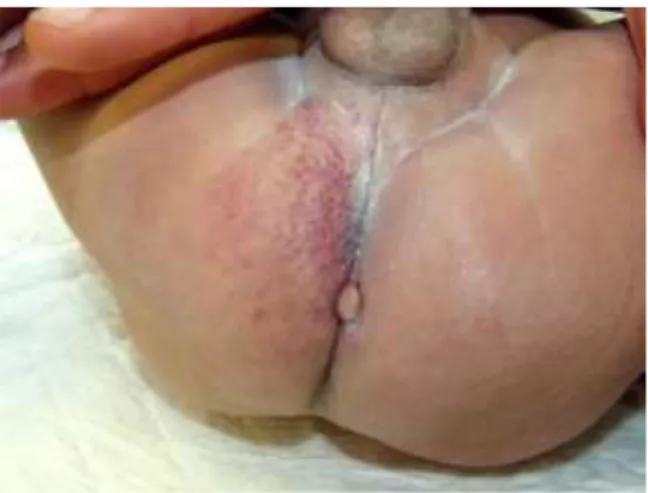 Fig. 3b : Aspect tubéreux de l’HI à 5 mois 