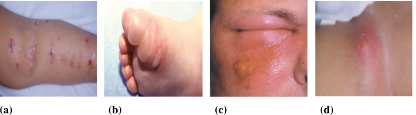 Fig. 2 : Les différents types des infections Staphylococciques. (a): Impétigo Staphylococcique  de la jambe, (b):Impétigo bulleux Staphylococcique, (c):Folliculite de la joue, (d):Abcès 