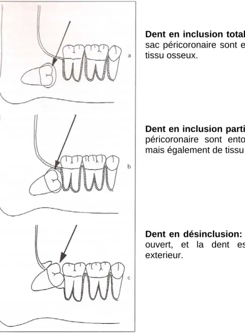 Figure 1: dent incluse, dent en inclusion partielle, dent en désinclusion 