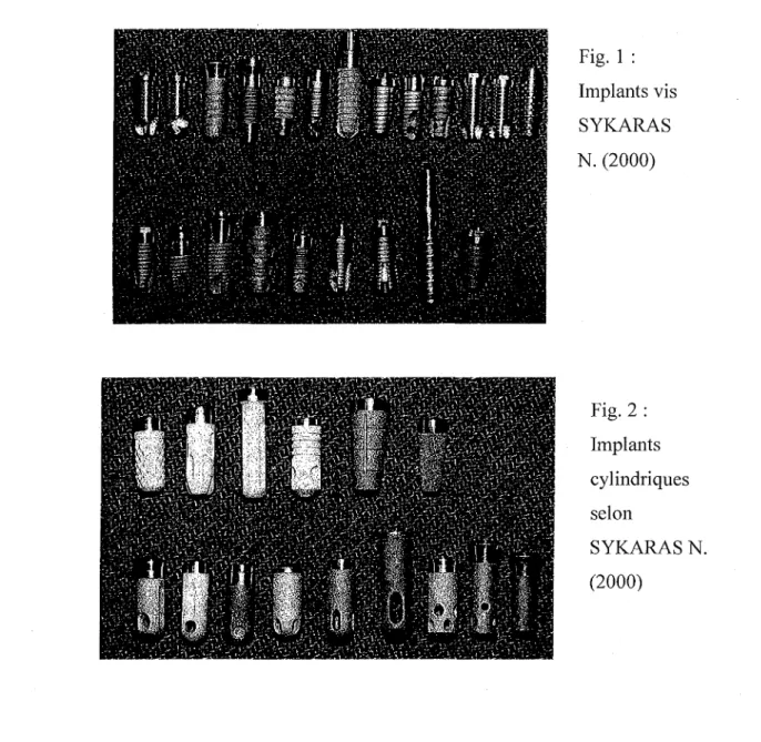 Fig. 1 : Implants vis SYKARAS N. (2000) Fig. 2 : Implants cylindriques selon SYKARASN
