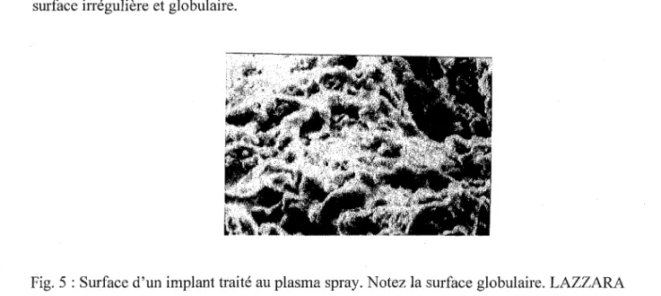 Fig. 5 : Surface d'un implant traité au plasma spray. Notez la surface globulaire. LAZZARA et coll