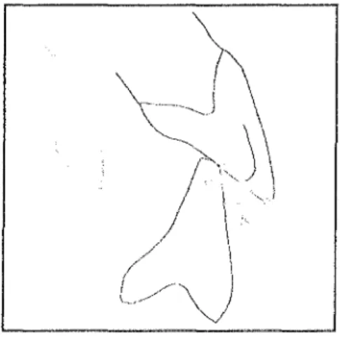 Figure 9 : Le triangle de SLA VICEK définit la pente incisive relative au surplomb et au recouvrement