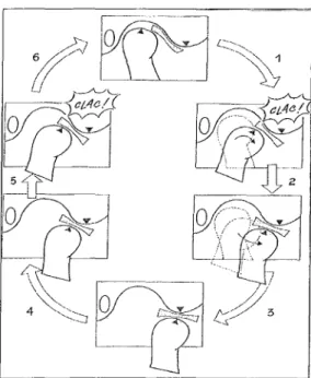 Figure 16 : Luxation discale réductible.