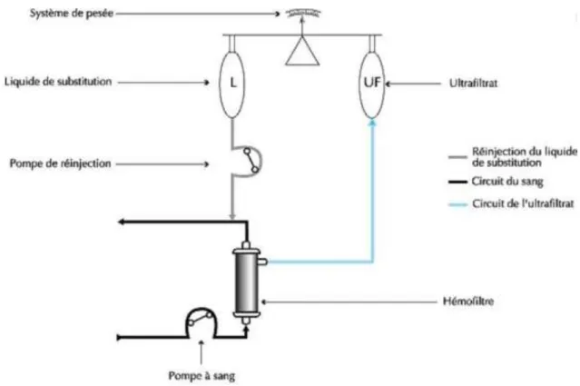 Figure 2 : Schéma d'un système d'hémofiltration en mode post-dilution avec réinjection du  liquide de substitution à la sortie de l'hémofiltre [9] 