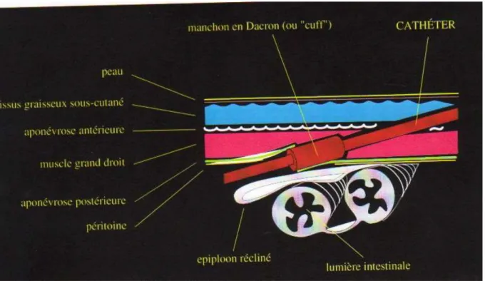 Figure 7 : Cathéter à travers la paroi abdominale 