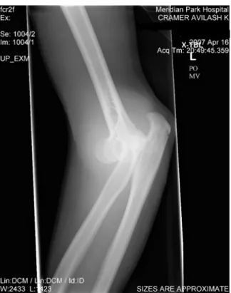 Figure 1-1: X-ray radiograph of the author’s arm following a regrettable rock climbing incident.