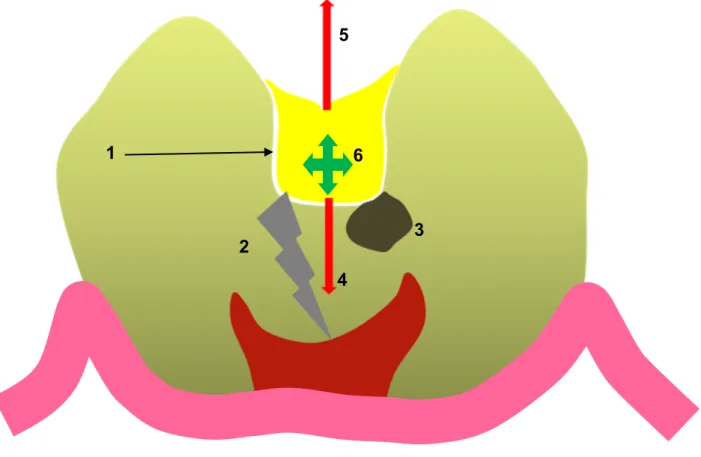 Figure  1  :  schématisation  des  phénomènes  potentiels  secondaires  au  placement  d’un matériau d’obturation à base de résine dans une cavité dentaire : 