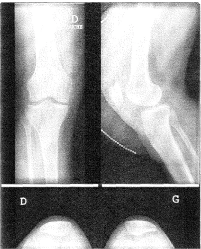 Figure  1. Radiographies du  genou au  4""  jour  post  traumatique. 