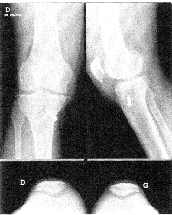 Figure 6. Radiographies des genoux en 2005. 