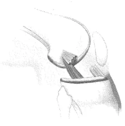 Figure 13. Illustration de la rupture du ligament croisé antérieur. Internet. 