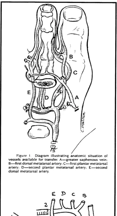 Figure  2 .   Illustration of an intercalated  arterial graft of  the radial artery  Identification of  B  to E same a s  in  Figure  1 
