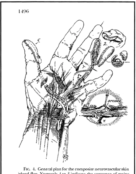 Figure 17  Dessin  de  J.W.  LITTLER  :  resensibiiisation  du  pouce  par  lambeau  pédiculé  neurovasculaire au dépens du quatrième doigt