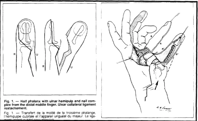 Figure 24  Procédé  de  LODA  :  reconstruction  du pouce  par  transfert  partiel  composite du  quatrième doigt sain  +  greffon iliaque