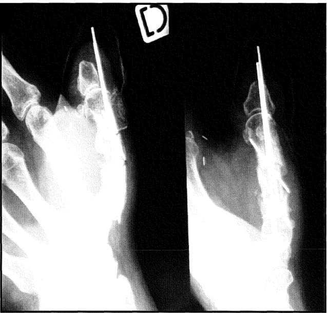 Figure 27  Procédé de MATEV  :  Radiographies post opératoires 1 mois après mise en place  du greffon 