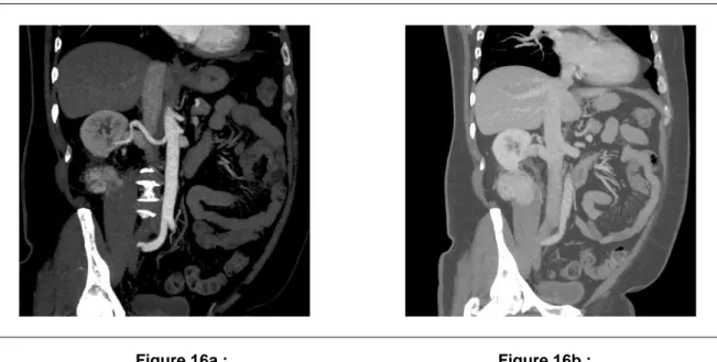 Figure 16a :  Figure 16b :  Uro-angio-scanner : reconstruction frontale oblique (dans le plan du pédicule)