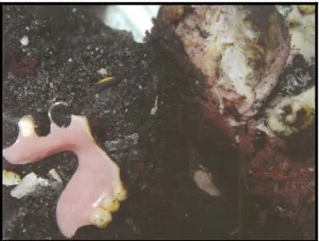 Figure 2 : photographie de la découverte d’une prothèse en résine dans la cavité buccale d’un individu  carbonisé
