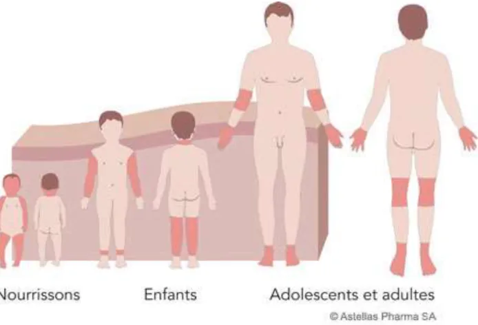 Figure 6 : Localisation des lésions dans la dermatite atopique suivant l’âge du patient (SkinSence, 2015)