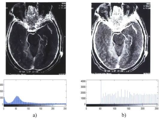 Figure 4.10:  Sample  brain CT image  with  histogram equalization.