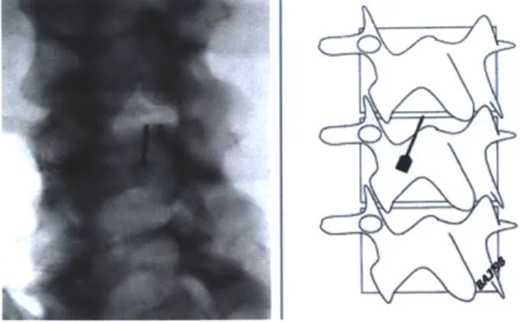 Figure  5.  Epidural needle  after have  been guided into the epidural space with corresponding schematic view[9]