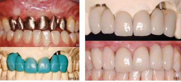 Figure I-63 b : Adaptation des bords en  céramique au collet des dents. (45) 