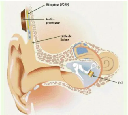 Figure 10 : implant d’oreille moyenne 