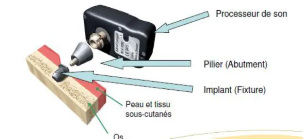 Figure 23 : Schéma annoté d’une BAHA 
