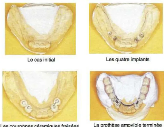 Figure 57: Cas clinique à double appui pour un  édentement mandibulaire de classe I de 