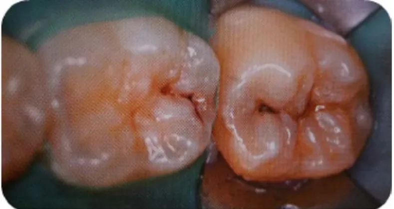 Figure 9 : Situation clinique après l'éviction carieuse. 