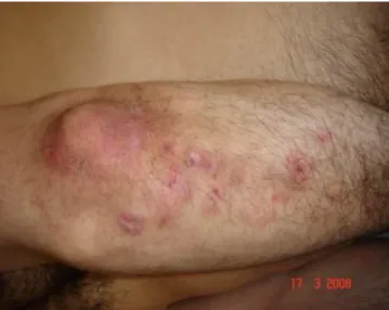 Figure 2: Dermatite herpétiforme au niveau du coude d'un patient (http2) 