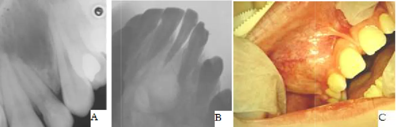 Figure 19 : A :  La radiographie