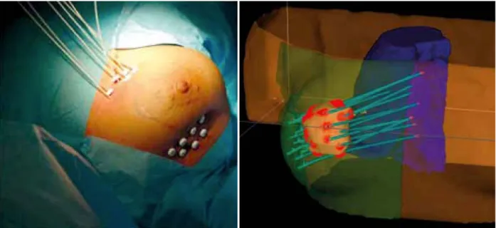 Figure  8  :  Curiethérapie  interstitielle  contre  le  cancer  du  sein  et  exemple  de  plan  de  traitement 3D indiquant la cible, les applicateurs et les organes critiques (44) 