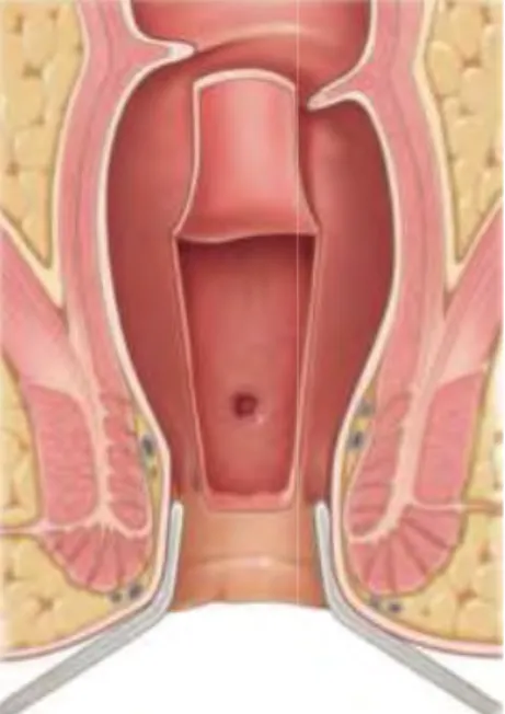 Figure n°2 :  Tracé en U 