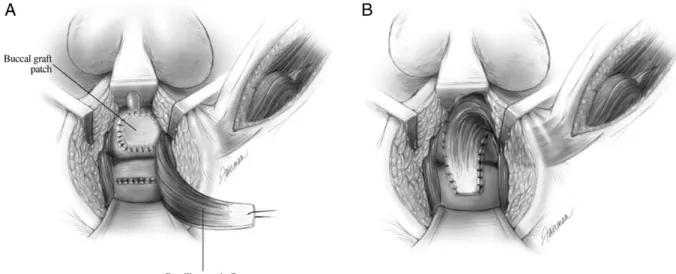 Figure  4 :  Lambeau  d’interposition  de  muscle  gracilis  avec  fermeture  de  l’urèthre par une greffe de muqueuse buccale (A), et avec lambeau fixé au  tissu péri-urèthral (B)