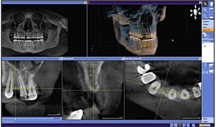 Figure  8 :  logiciel  Galileos  Implant® :  différentes  coupes  issues  des  données  d’imagerie (source : Patel et Caponigro, 2016) 