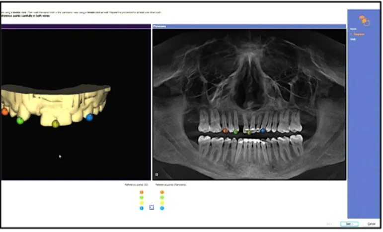 Figure  9 :  logiciel  Galileos  Implant® :  sélection  des  points  de  correspondance