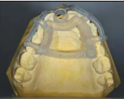 Figure 30 : guide chirurgical  « SMOP » (source : Kurt, 2014)  Une fois le guide chirurgical réalisé, la pose implantaire guidée peut débuter