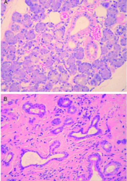 Figure 20 : Histologie d’une glande salivaire normale (A) et d’une glande irradiée (B)   56