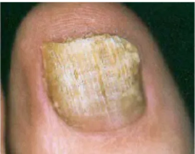 Figure   13   :   Une   onychomycose   du   pied   (11)   