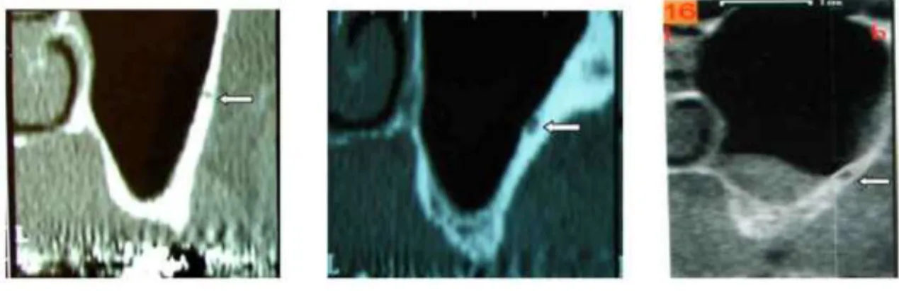 Figure 4 : visualisation du canal de l’artère alvéolo-antrale au sein de la paroi sinusienne sur des coupes de scanner (d’après  Mardinger, 2007) 