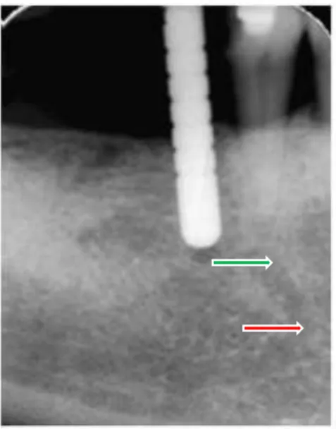 Figure 5 : radiographie rétro-alvéolaire mettant en évidence la position du foramen mandibulaire (flèche verte) ainsi qu’une  boucle du canal du nerf alvéolaire inférieur (flèche rouge) (d’après Greenstein, 2008) 