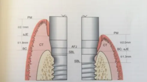 FIGURE 10 : DÉBUT DE L’EXPERIENCE . COTE TEMOIN A GAUCHE, COTE TEST A  DROITE.  SOURCE : ESTHÉTIQUE ET IMPLANTOLOGIE